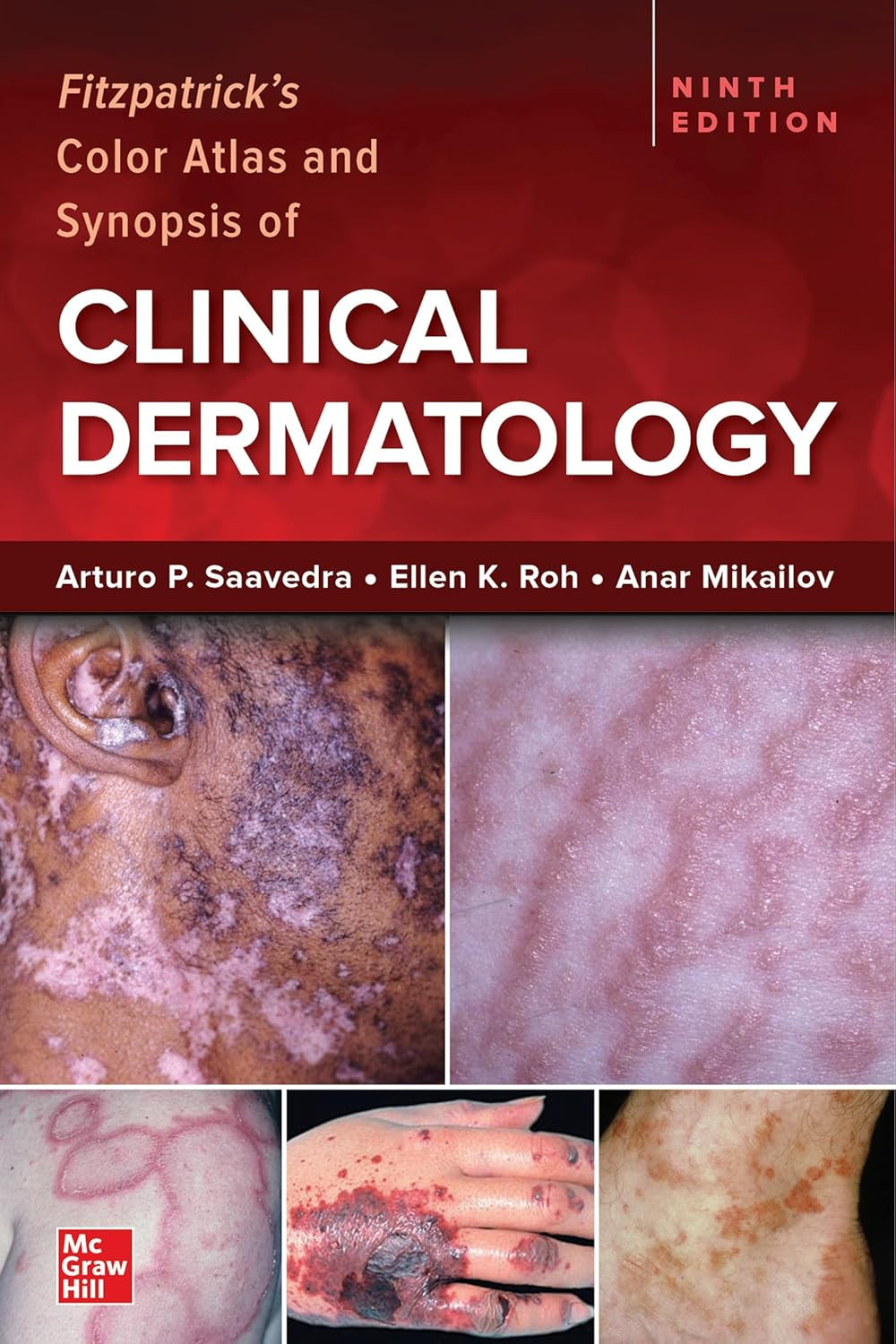Fitzpatrick’S Color Atlas and Synopsis of Clinical Dermatology, Ninth Edition